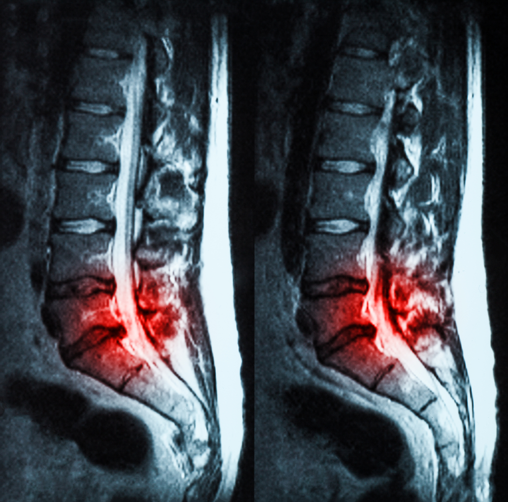 Spinal Stenosis: Definition, Causes, Symptoms, Diagnosis, and