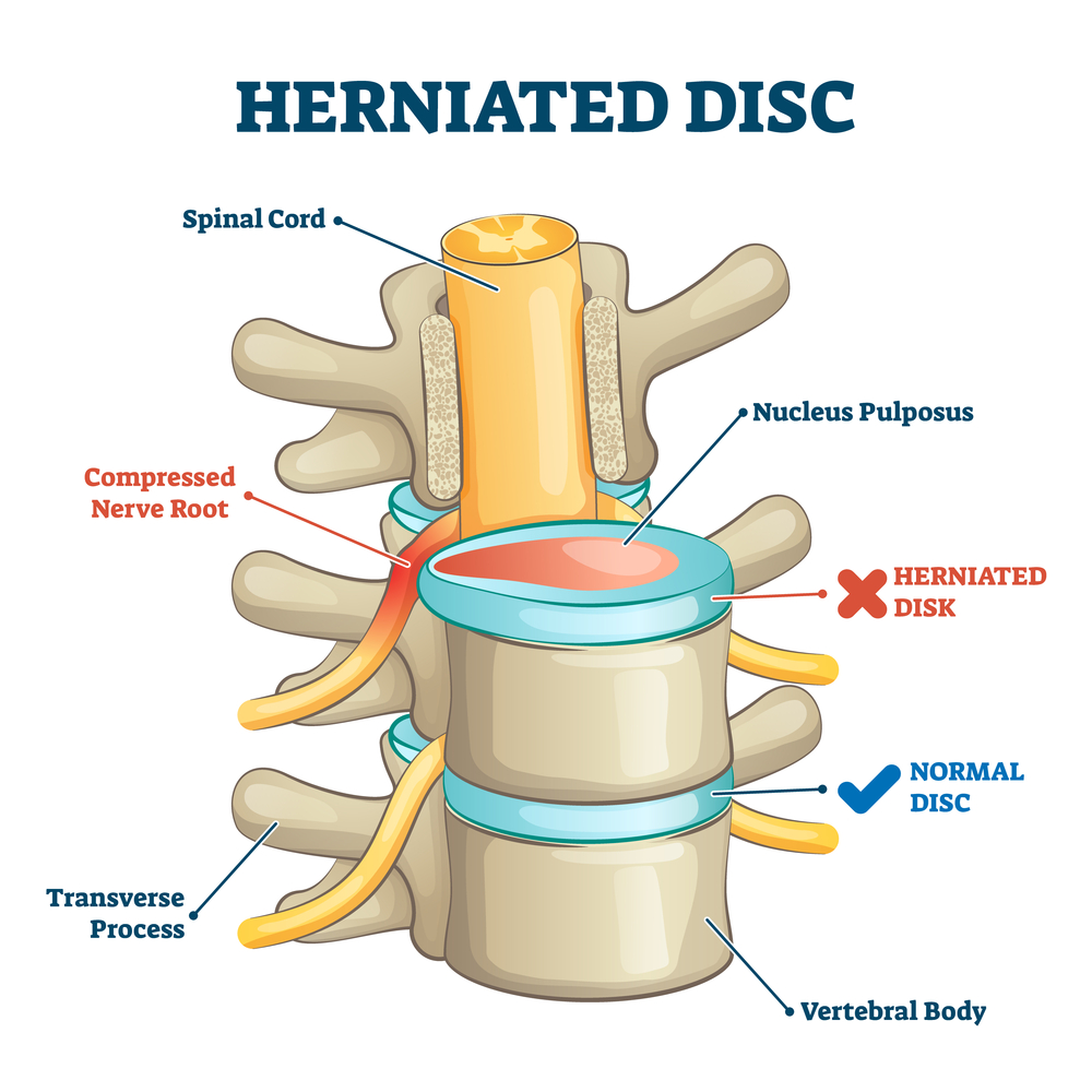 L4 L5 Disc Herniation Explained | Premia Spine