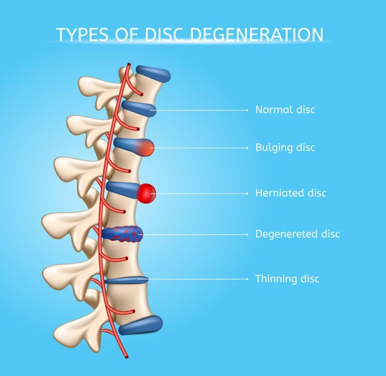 Degenerative Disc Disease Surgery | Premia Spine Blog