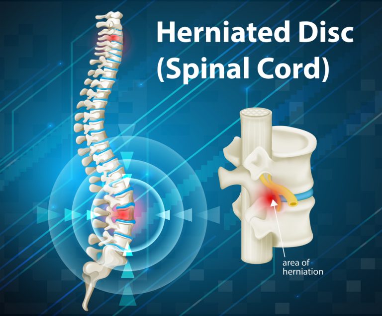 How to Heal a Herniated Disc Quickly? | Premia Spine Blog