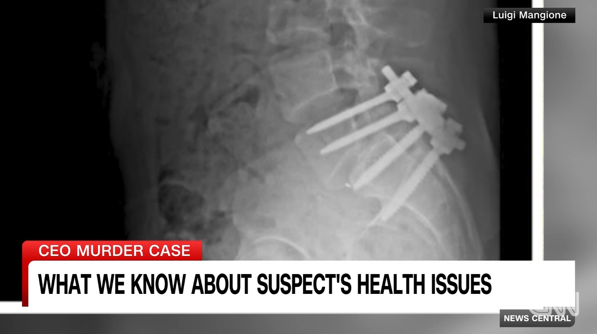 The Hidden Struggle of Spondylolisthesis Understanding Luigi Mangione